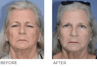 69 year old female treated with Bilateral Upper Blepharoplasty, 1 month post-op