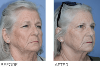 69 year old female treated with Bilateral Upper Blepharoplasty, 1 month post-op