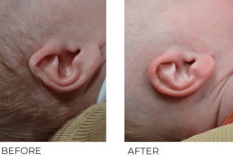 3 week old infant treated for ear deformity with EarWell Correction Right Ear, 8 weeks post-correction