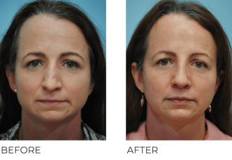 35-44 Year Old Woman Treated With Rhinoplasty 1 Month Post-Op