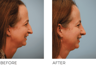 35-44 Year Old Woman Treated With Rhinoplasty 1 Month Post-op