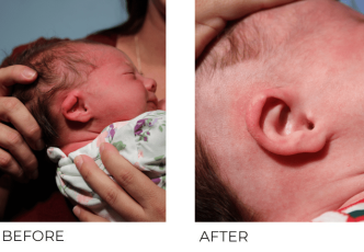6 day old infant treated for ear deformity with EarWell Correction Bilateral Ears, 9 weeks post correction