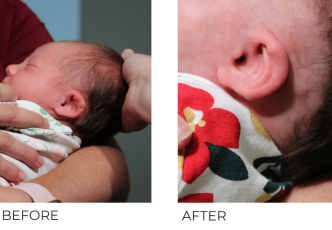 6 day old infant treated for ear deformity with EarWell Correction Bilateral Ears, 9 weeks post correction