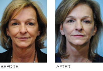 65-74 year old woman treated with Facelift 6 months postop A