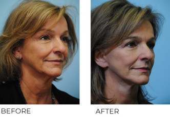 65-74 year old woman treated with Facelift 6 months postop