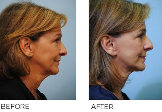 65-74 year old woman treated with Facelift 6 months postop