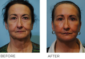 65-74 year old woman treated with Facelift 6 weeks ago