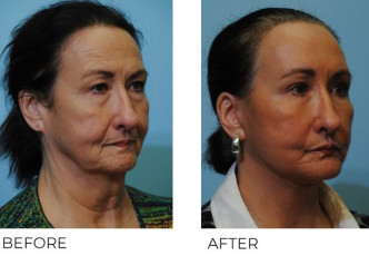 65-74 year old woman treated with Facelift 6 weeks ago