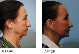 65-74 year old woman treated with Facelift 6 weeks ago