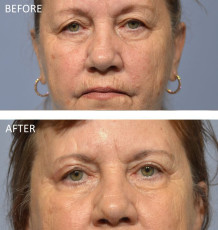 65 year old female treated with Bilateral Upper Blepharoplasty, 5 months post-op
