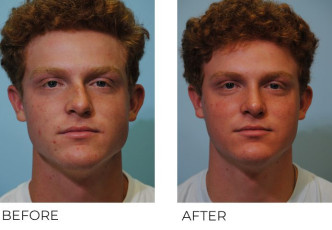 18-24 year old man treated with Rhinoplasty 1 year postop