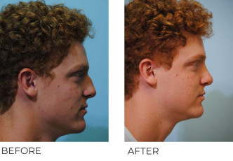 18-24 year old man treated with Rhinoplasty 1 year postop