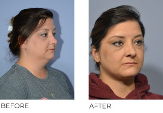 37 year old female treated with Cervical Liposuction and Small Implant Genioplasty, 5 months post-op
