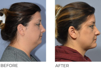 37 year old female treated with Cervical Liposuction and Small Implant Genioplasty, 5 months post-op