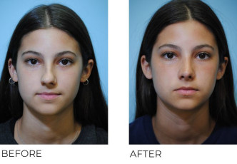 18-24 year old treated with Rhinoplasty 6 months postop