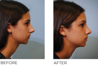 18-24 year old treated with Rhinoplasty 6 months postop