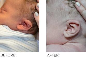 10 day old male treated with Bilateral EarWell Correction, 10 weeks post-correction