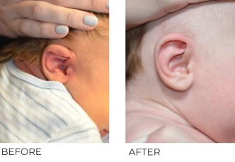 10 day old male treated with Bilateral EarWell Correction, 10 weeks post-correction