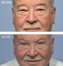 70 year old male treated with Mid-Forehead Lift and Bilateral Upper Blepharoplasty, 2 months post-op