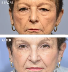 76 year old female treated with Bilateral Upper Blepharoplasty 2 months post-op