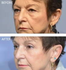 76 year old female treated with Bilateral Upper Blepharoplasty 2 months post-op