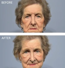 85 year old female treated with Bilateral Upper Blepharoplasty, 1 month post-op