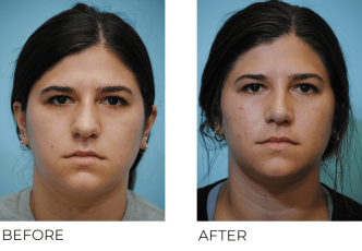 18-24 year old woman treated with Rhinoplasty 1 year postop