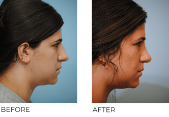 18-24 year old woman treated with Rhinoplasty 1 year postop