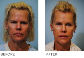 55-64 year old woman treated with Facelift 2 months postop