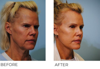 55-64 year old woman treated with Facelift 2 months postop