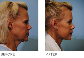 55-64 year old woman treated with Facelift 2 months postop