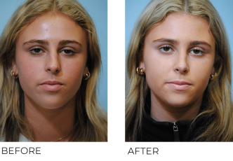 17 or under old woman treated with Rhinoplasty