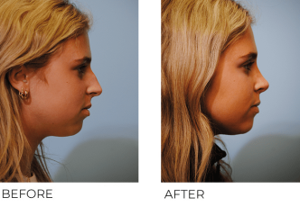 17 or under old woman treated with Rhinoplasty