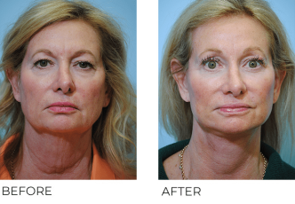 55-64 year old woman treated with Facelift 3 months ago