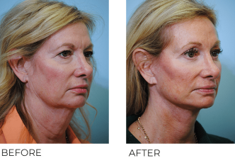 55-64 year old woman treated with Facelift 3 months ago