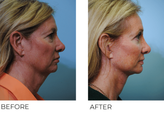 55-64 year old woman treated with Facelift 3 months ago