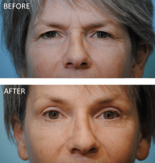 55-64 yr old woman treated with Blepharoplasty 3 months ago