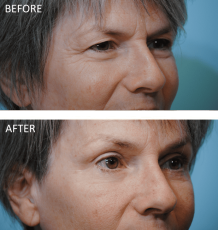 55-64 yr old woman treated with Blepharoplasty 3 months ago