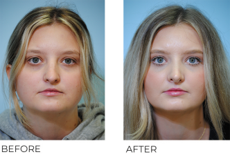 18-24 year old woman treated with Rhinoplasty 3 months ago