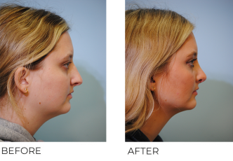 18-24 year old woman treated with Rhinoplasty 3 months ago