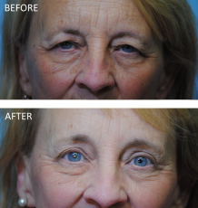 65-74 year old woman treated with Browlift 6 months ago