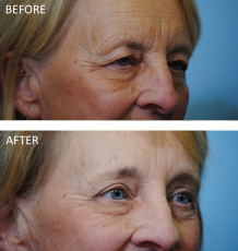 65-74 year old woman treated with Browlift 6 months ago B
