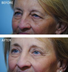 65-74 year old woman treated with Browlift 6 months ago