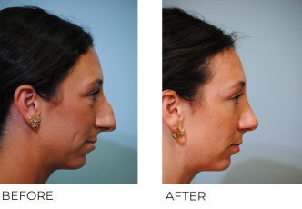 18-24 year old woman treated with Rhinoplasty 6 months ago