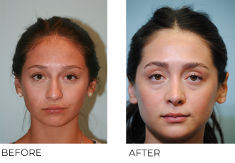 18-24 year old woman treated with Rhinoplasty 7 years ago A