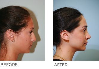 18-24 year old woman treated with Rhinoplasty 7 years ago B