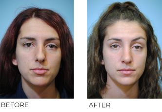 25-34 year old woman treated with Rhinoplasty 6 months ago