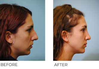 25-34 year old woman treated with Rhinoplasty 6 months ago