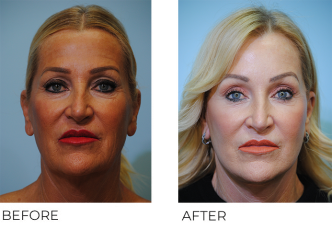 55-64 year old woman treated with Facelift 6 weeks ago