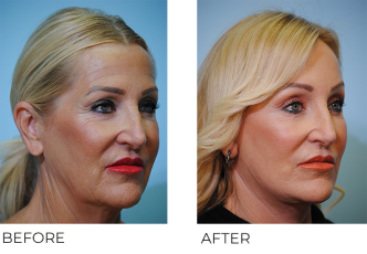 55-64 year old woman treated with Facelift 6 weeks ago